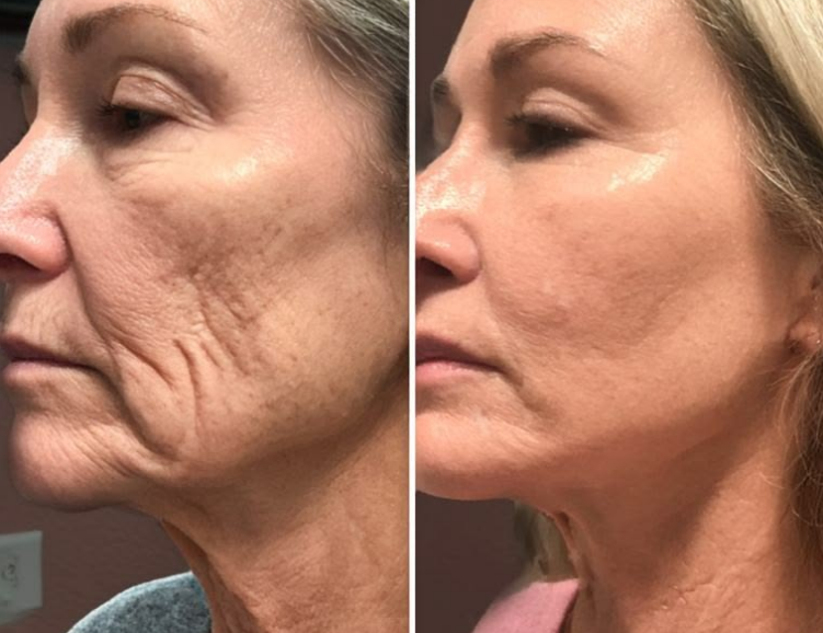 Client before and after treatment, comparison 5