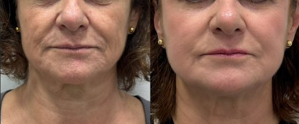 Client before and after treatment, comparison 4