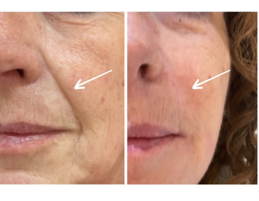 Client before and after treatment, comparison 1